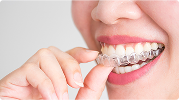 Invisalign Invisalign